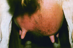 Mastitis-Euter