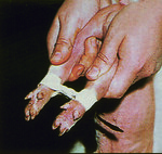 Bandagierung Spreizferkel