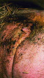 Gebärmutterentzündung